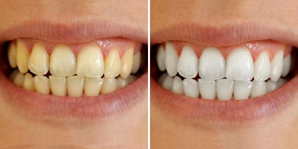 Whitening Master Coco Teeth Whitening - sort aktivt kul g)